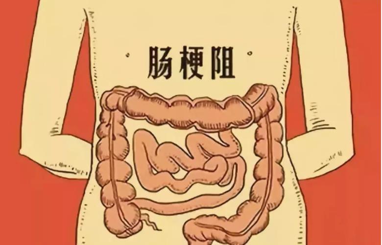 肠梗阻真磨人，这些行为有效预防