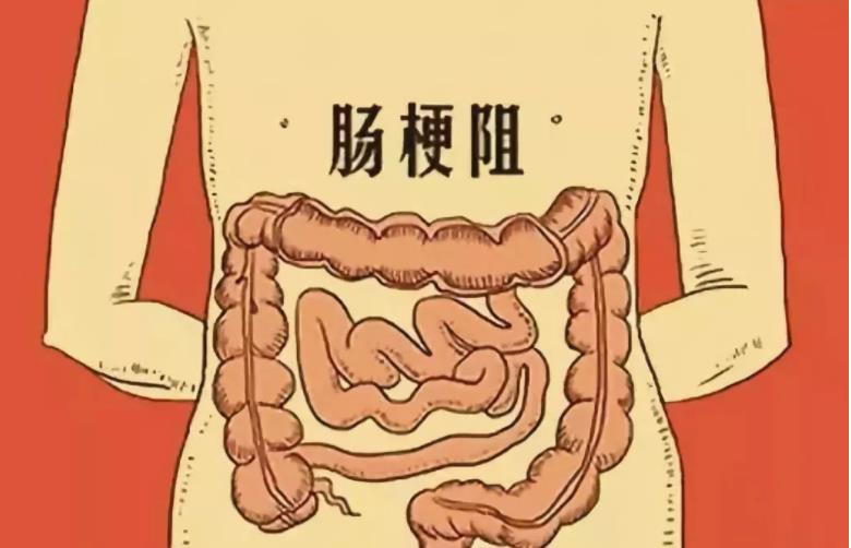 肠梗阻的发病率